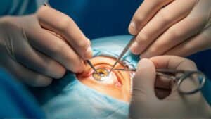 <p>¿Preocupado por la cirugía de cataratas? Conoce cuál es el procedimiento detallado, estadísticas de éxito y cómo recuperar una visión nítida.</p>
