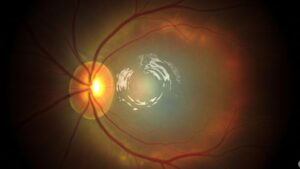 <p>La degeneración macular es una condición seria. Conoce cómo proteger tus ojos y qué debes hacer para evitar la pérdida de la visión central. </p>
