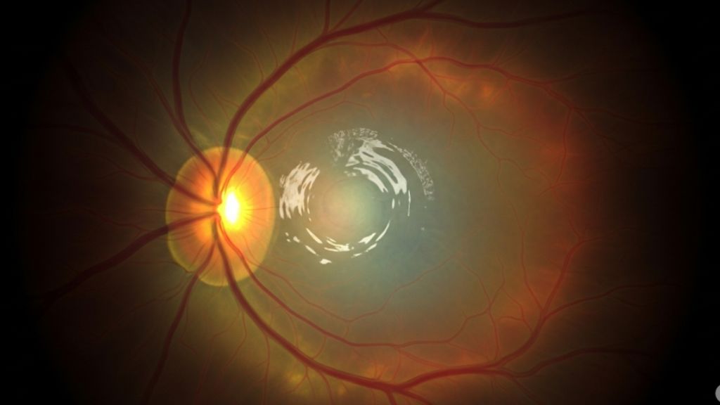 Degeneración macular