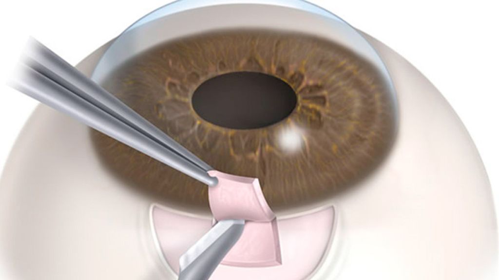 La trabeculectomía es una técnica quirúrgica para personas con glaucoma.