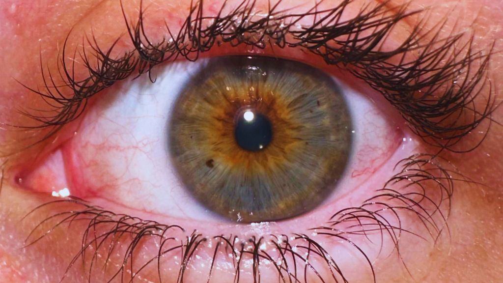 El nevus ocular es una agrupación de células llamadas melanocitos
