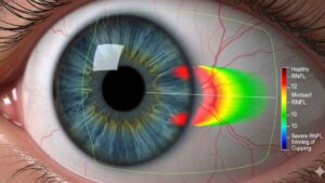 La foto 3D de tus ojos: cómo la OCT revela secretos ocultos del glaucoma