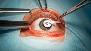 Mitos y verdades de la cirugía de la válvula de Ahmed: ¿La solución definitiva para el glaucoma?