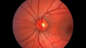 <p>¿Un ojo rojo y un dolor insoportable? Aprende a diferenciar un derrame de un ataque de glaucoma agudo de ángulo cerrado. Descubre sus síntomas, causas y tratamientos de emergencia.</p>
