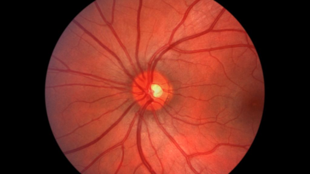 glaucoma de ángulo cerrado
