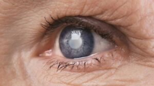 <p>¿Tomas corticoides? Descubre la conexión entre estos medicamentos y las cataratas. Conoce los riesgos, síntomas y cómo proteger tu vista. </p>
