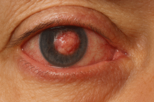 <p>Si te has sometido o te vas a someter a una cirugía de glaucoma, como la trabeculectomía, probablemente has oído hablar de la «ampolla de filtración». Pero, ¿sabes realmente por qué este pequeño reservorio es tan crucial y por qué su correcta cicatrización define el éxito o fracaso de toda la intervención? En este artículo […]</p>
